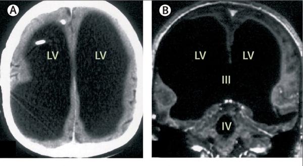 Život bez mozga je moguć!